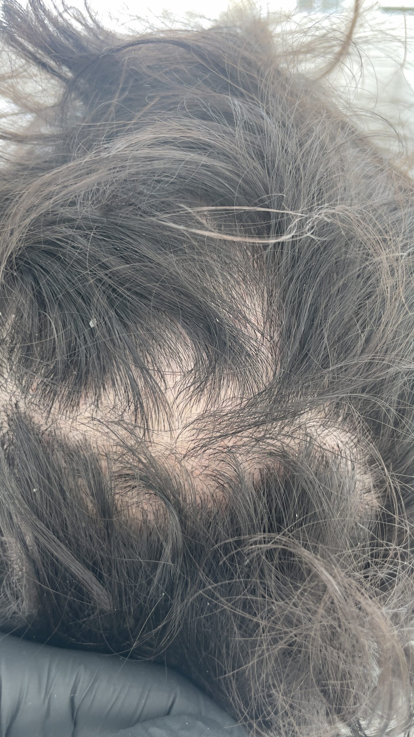 Antes tratamiento alopecia Avec Belle