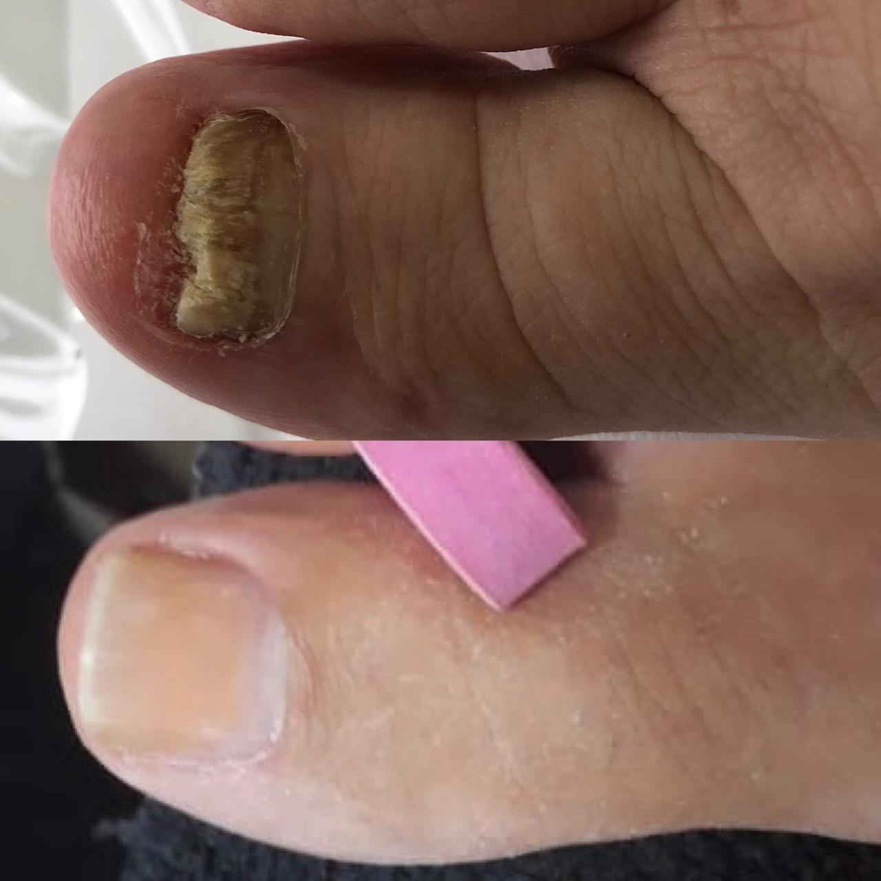 Onicomicosis tratamiento láser Avec Bëlle