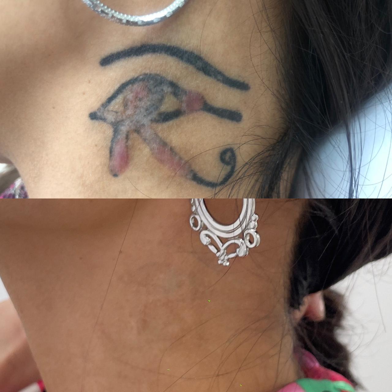 Eliminación de tatuajes con láser Avec Bëlle