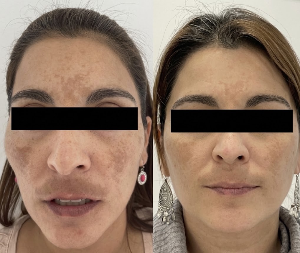 Antes y después — melasma facial