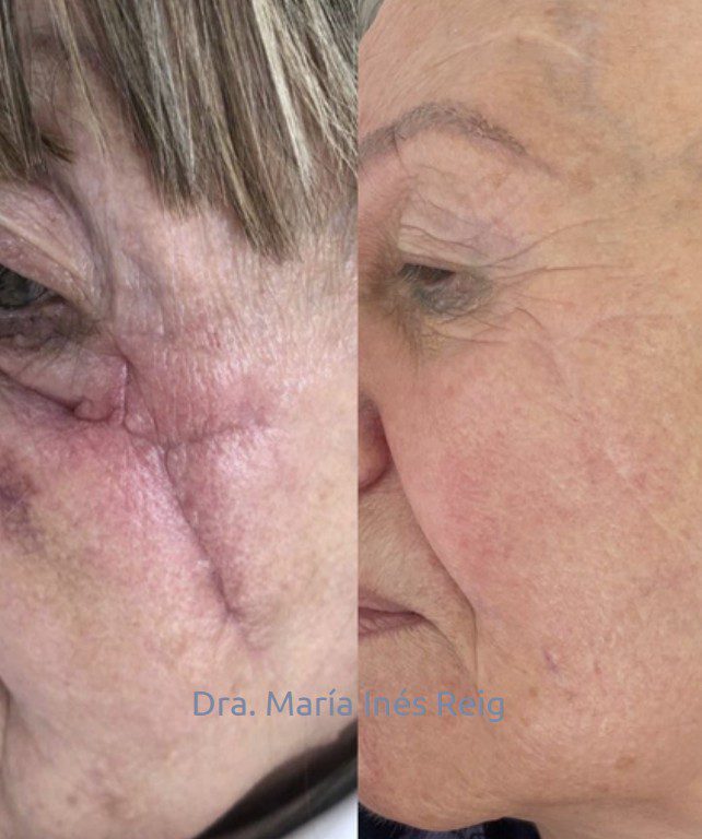 Antes y después cicatriz en Y rostro