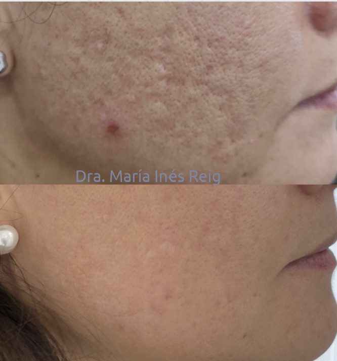 Antes y después cicatrices de acné rostro
