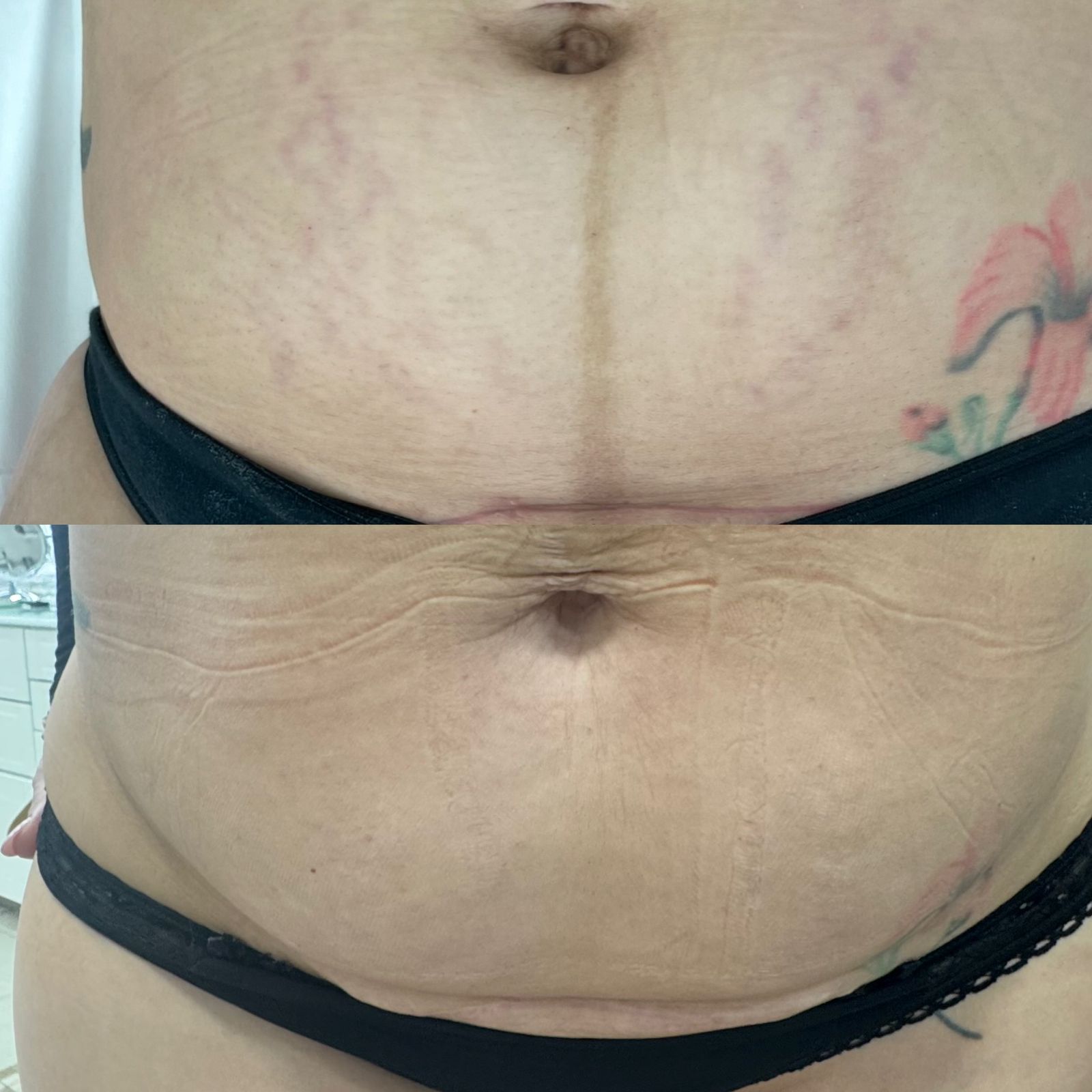 Antes y después tratamiento estrías