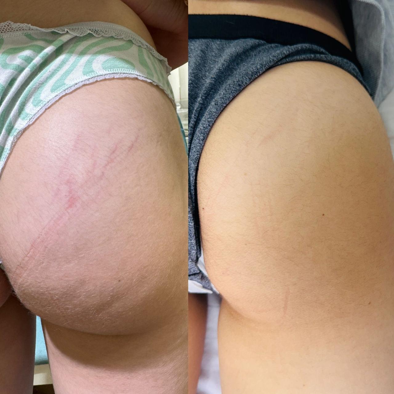 Antes y después tratamiento estrías