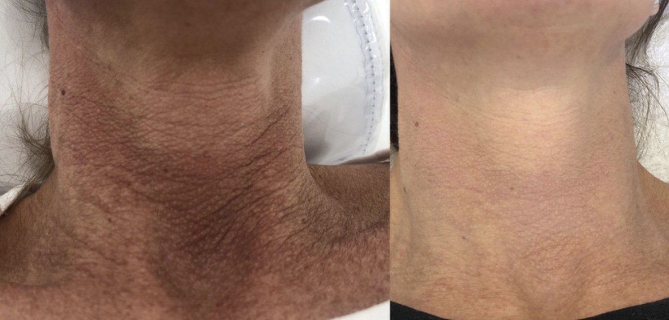 Antes y después — lesiones pigmentarias en cuello