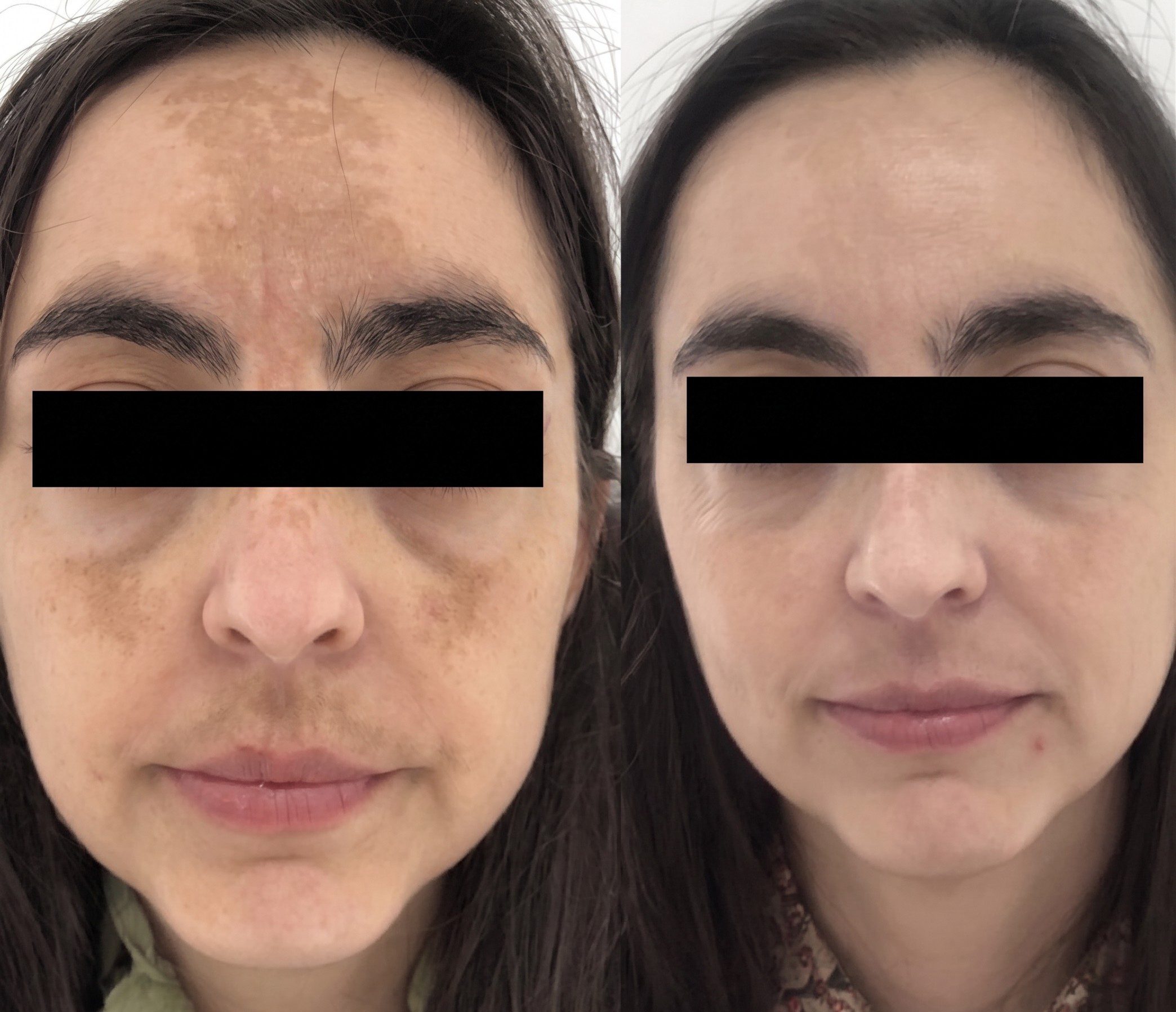 Antes y después — melasma facial