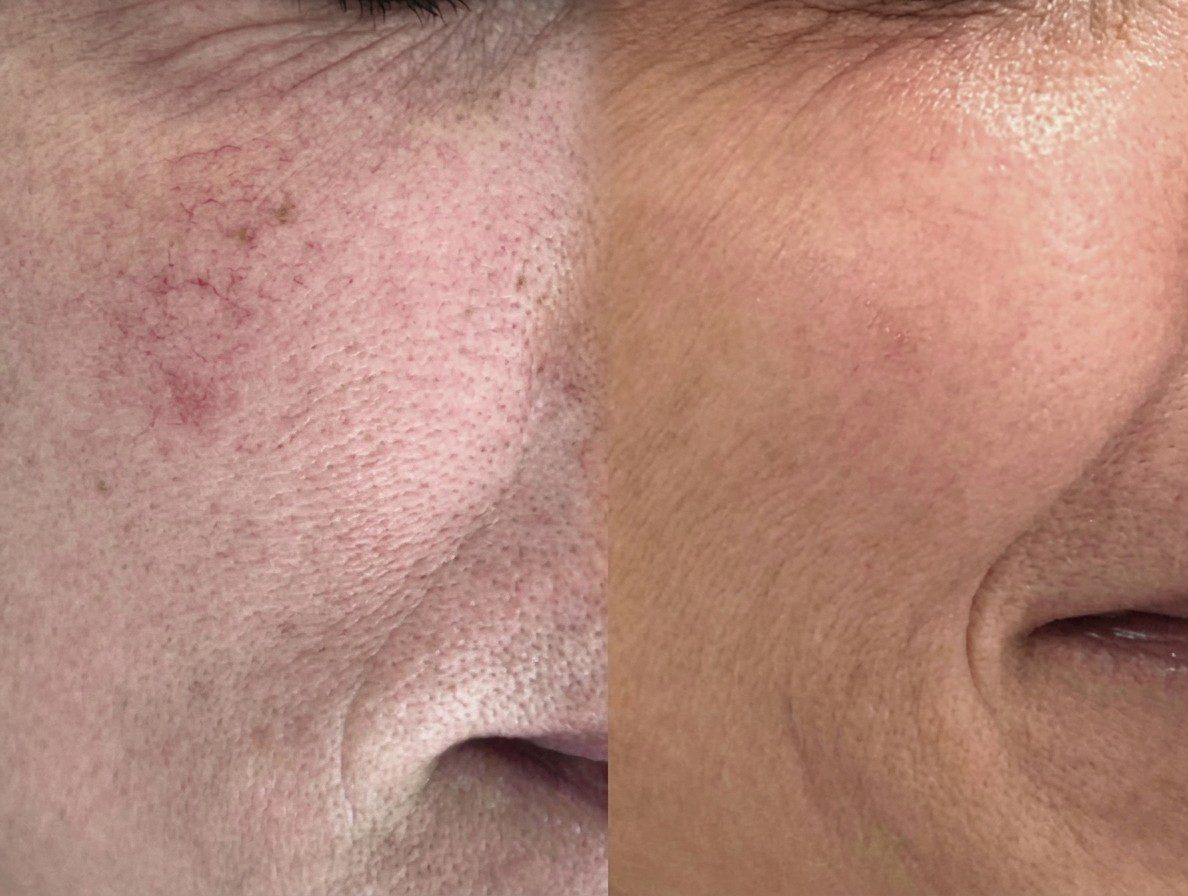 Antes y después lesiones vasculares piernas