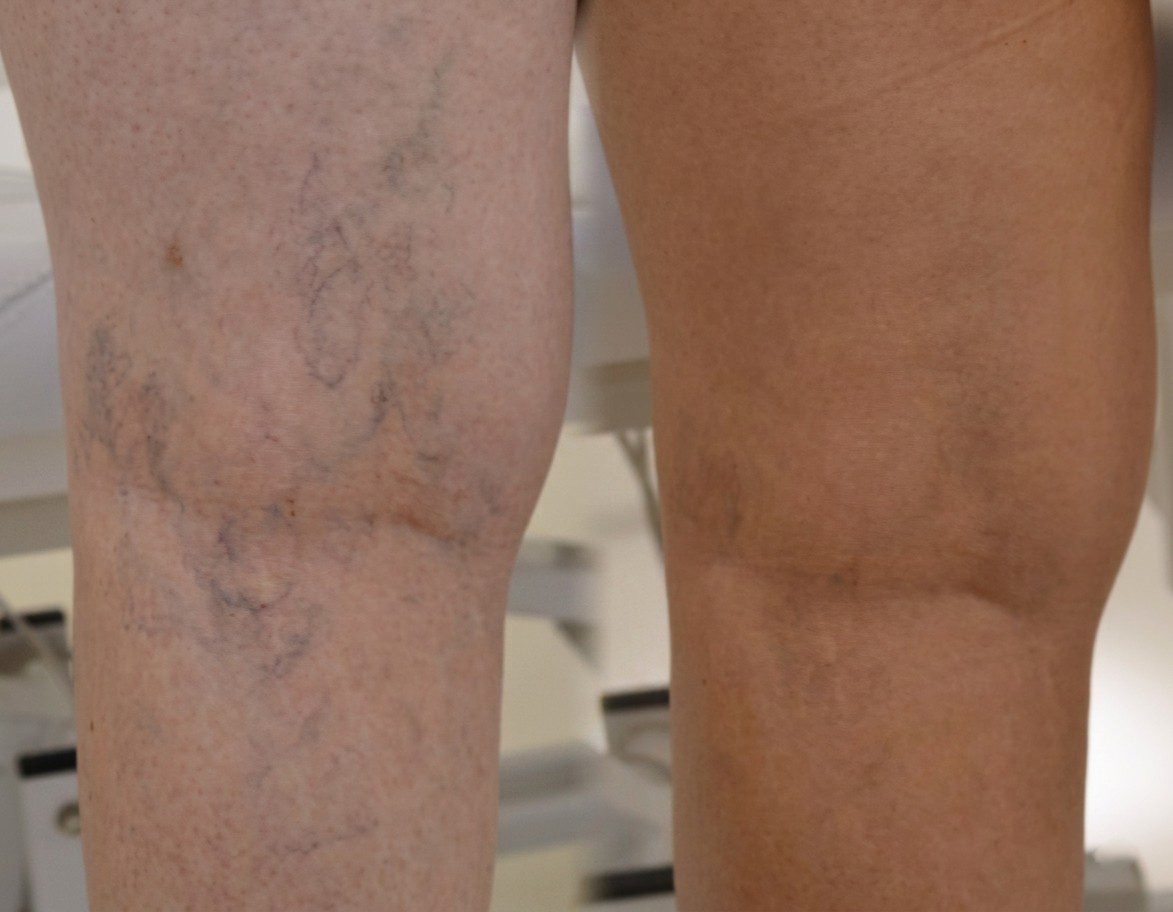Antes y después lesiones vasculares rostro